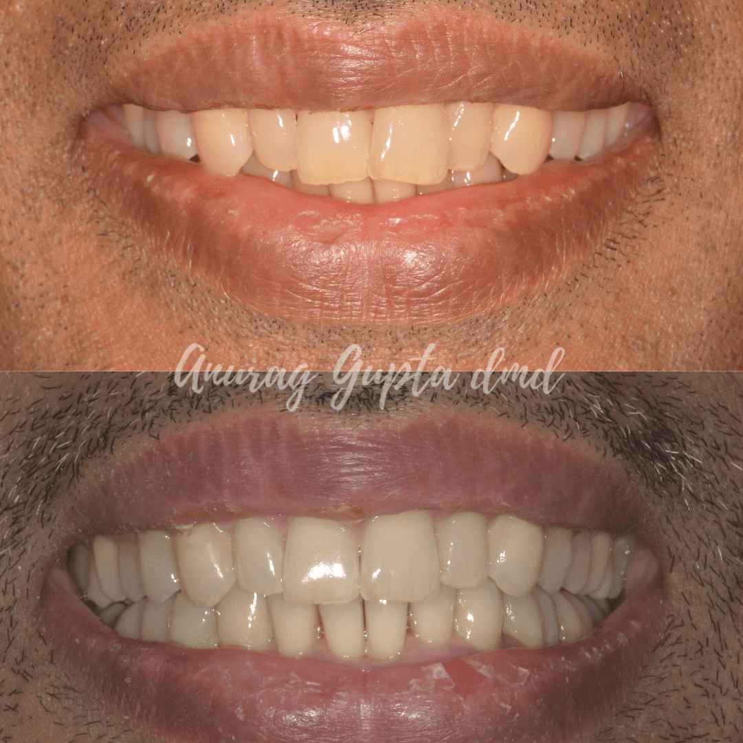 Clear aligner therapy